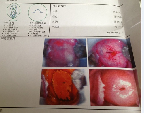 宮頸糜爛最新治療手段